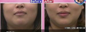 セルキュア4tの効果は